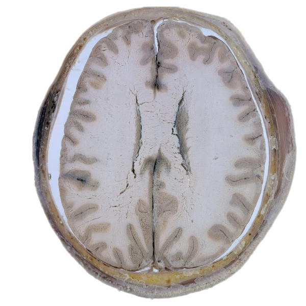颅脑CT连续断面-5
