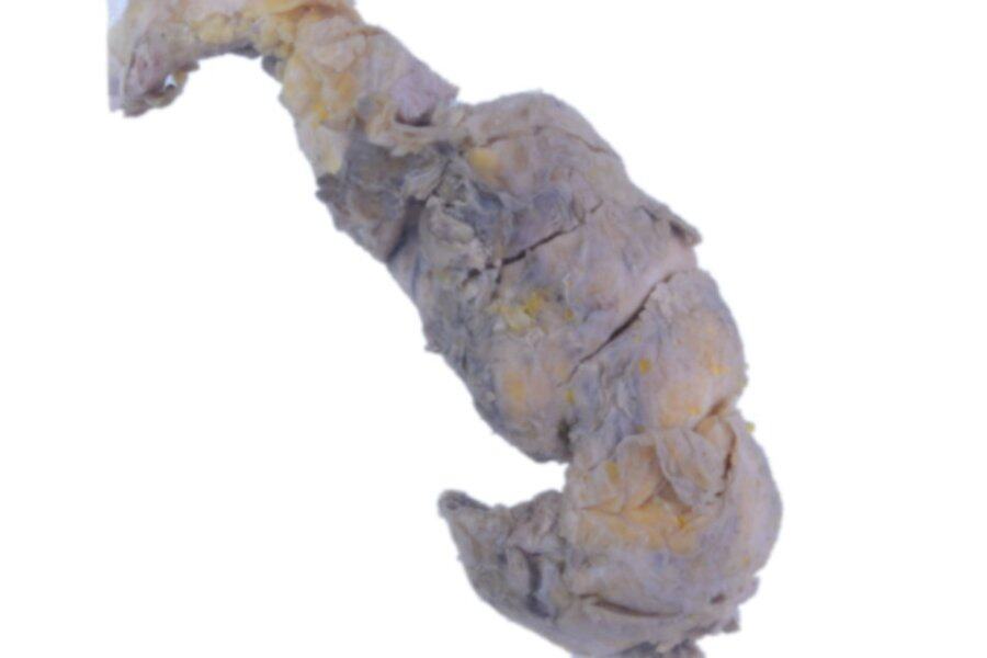 胃肠道类瘤